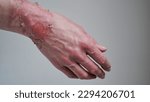Small photo of Close-up of a woman's hand with a burst blister from a boiled water burn, broken skin, 1st or 2nd degree burn. Painful wound. Thermal burn. Skin peels off after a burn, wound treatment. macro photo.
