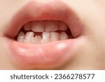 Small photo of The teeth of a six-year-old child, a crookedly growing incisor in place of a lost milk tooth