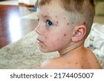 Small photo of Natural vaccination. Contagious disease. Sick child with chickenpox. Varicella virus or Chickenpox bubble rash on child body and face. High quality photo
