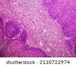 Small photo of Photomicrograph of an sinonasal inverted papilloma (SNIP), a benign tumor that may occur in the nasal cavity or paranasal sinuses