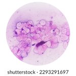 Small photo of Microscopic analysis showing Epidermal inclusion cyst, swelling of left thigh