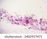 Small photo of Photomicrograph of Paps smear: Inflammatory smear with HPV related changes. Cervical cancer. SCC