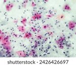 Small photo of Gardnerella vaginalis infection pap smear under microscopy.