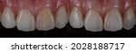 Small photo of Non vital teeth bleaching or internal bleaching, before and after shot. Individual teeth whitening on one central incisor.
