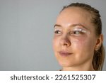 Small photo of woman face after plastic surgery on eyes, yellow red color skin bruising, blepharoplasty operation, swollen bruised eyelids, incisions stitches covered with medical tape, wound closure strips, edema