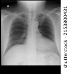 Left lung lower lobe collapse ...