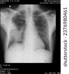Small photo of Detailed X-ray of lung atelectasis with middle lobe consolidation.