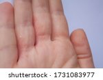 Small photo of Hand with interdigital dermatitis that goes to the dermatologist for edema, itching, pain and suppuration