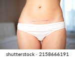Small photo of Mom's abdomen after cesarean section. Scar seam. bodypositive diversity Real motherhood. Lifestyle. High quality photo