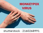 Small photo of Monkeypox new disease dangerous over the world. Patient with Monkey Pox. Painful rash, red spots blisters on the hand. Close up rash, human hands with Health problem. The word Monkeypox virus.