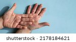 Small photo of Male hands with Monkeypox rash. Patient with MonkeyPox viral disease. Close Up of Painful rash, red spots blisters on the skin. Human palm with Health problem. Banner, copy space. Allergy, dermatitis.