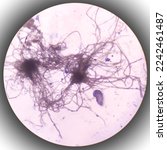 Small photo of Microscopic fungi Malassezia furfur, showing yeast cells and hyphae. They are associated with dandruff, seborrhoeic dermatitis and tinea versicolor. Skin scraping for fungus.