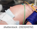Small photo of Abdominal dissension with a small umbilical hernia in an infant