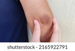 Small photo of portrait showing the fingers touching the crook of the arm, problem black elbow of the woman, concept health care.