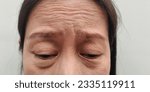 Small photo of close up the flabbiness and flabby skin, Wrinkle and forehead lines, Dullness and dark spots, cellulite and bag under the eye, ptosis beside the eyelid on the face, health care and beauty concept.