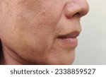 Small photo of close up the flabbiness and wrinkle beside the mouth, Flabby skin, dark spots and rough skin, blemish, the mouth dry skin, freckles and pore on the face of the woman, health care and beauty concept.