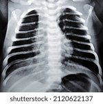 Small photo of Selective focus of a plain chest x ray for a newborn infant in incubator with a right lung congenital pneumonia at the right apex where small opaque patches could be seen indicating the inflammation
