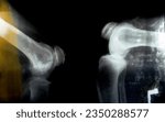Small photo of Old retro Plain X ray of the right knee shows apparent joint osteoarthritis by Kellgren and Lawrence system for classification of osteoarthritis with definite osteophytes and join space narrowing