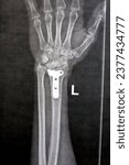 Small photo of Plain x ray showing a recent fissure fracture at the lower part of a left radius bone, also showing a previous internal fixation of the wrist join with plate and screws of a previous fracture