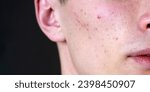 Small photo of Man with pimples on skin. Acne and pimple on skin. Dermatology, puberty man. Pimples problem. Young Man with Pimple on face. Care skin, Pimples problem. Guy Pimple face, close up.
