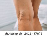 Small photo of Legs with woman with varicose veins and pronounced mesh.
