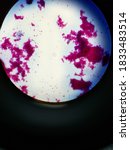 Small photo of Acid-fast bacilli staining of nontuberculous mycobacteria
