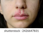 Small photo of close-up of a woman with herpes on her lip: vesicle and blister