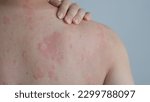 Small photo of Close up image of skin texture suffering severe urticaria or hives or kaligata on back. Allergy symptoms.