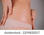 Small photo of Woman touching her stretch marks. Female hips with a stretch marks