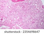 Small photo of Photomicrograph of primary particulate contracted kidney, illustrating shrunken renal tissue and abnormal nephron structures.