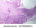 Small photo of Photomicrograph of viral pneumonia, revealing inflammation and cellular damage caused by a viral respiratory infection.