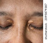 Small photo of Xanthelasma or small skin blemishes that happen due to a buildup of fats under the surface of the eyelids skin. Sign of high cholesterol. Malay Asian lady. Tanned and dry skin. Dermatology.