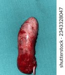 Small photo of gross specimen of gall bladder. after laparoscopic cholecystectomy due to chronic and acute cholecystitis