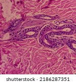 Small photo of Abduminal wall skin tissue histology. Ashy dermatosis, show basal vacuolization along dermoepidermal junction, superficial perivascular lymphocytic infiltration. Chronic skin diseases.