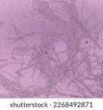 Small photo of Microscopic fungi Malassezia furfur, showing yeast cells and hyphae. dermatophytes, Nail scraping or skin scraping for fungus test in microbiology laboratory.
