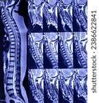 Small photo of MRI of Cervical Spine and screening. Cervical spondyloarthropathy, thecal sac indentation at C4-C5 and C5-C6 level, indentation with nerve roots compression at C5-C6 level.
