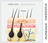 hair loss structure vector... | Shutterstock .eps vector #1465033514