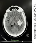 Small photo of A 51-year-old male patient has intraparenchymal hemorrhage on brain CT performed after sudden onset of weakness in the right arm. In Konya Turkey, 2023