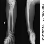 Small photo of x ray image of distal radius fracture smith fracture