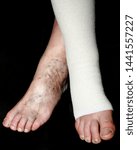 Small photo of Leg. Varicose, veins. Phlebeurysm. Thrombophlebitis. Elastic bandage.