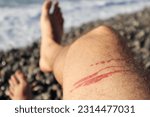 A jellyfish sting burn on a man's leg, on the beach