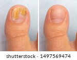 Small photo of Before and after topical antifungal treatment is seen in the big toe of a person suffering from Onychomycosis, a fungal infection causing yellowing of the toenail.