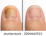 Small photo of Before and after topical antifungal treatment is seen in the big toe of a person suffering from onychomycosis, a fungal infection causing yellowing of the toenail