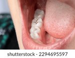 Small photo of Close up of a woman's mouth with dental caries. Macro of teeth with black spots due to the action of caries bacteria. Oral hygiene and dental care concept.