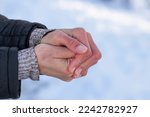 Small photo of Women's frozen hands in the cold.Women's hands with dry skin and red fingers in the cold in winter.The concept of skin care in winter.