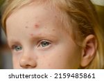 Monkeypox new disease dangerous over the world. Selective focus. Close-up of a Caucasian girl with pimples and ulcers on her face.