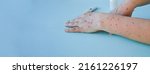 Small photo of Monkey pox virus, a new world problem of modern humanity. Close-up of the hands of a sick person with pimples and blisters wild banner. Smallpox vaccine.