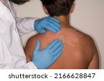Small photo of A doctor is evaluating the extent of the skin abrasion on the back of an 11-year-old child from a medium-intensity sunburn.