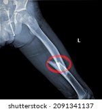 Small photo of A Femoral shaft fracture of children. oblique displaced fracture of femur. Terrifiying Fracture of femur due to trauma.Broken thigh.