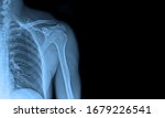 X ray images shoulder joint to...